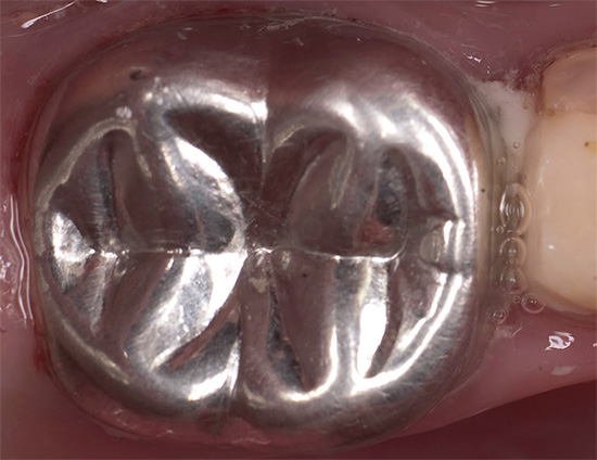 E parece o mesmo dente com uma coroa já instalada.