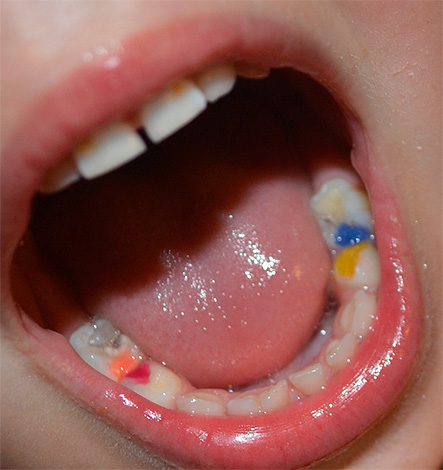 É assim que ficam os recheios coloridos dos dentes de leite, às vezes as crianças gostam de se exibir para os amigos.