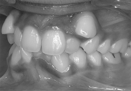 A perda (ou remoção) muito rápida de dentes decíduos pode levar facilmente a uma má oclusão subsequente.