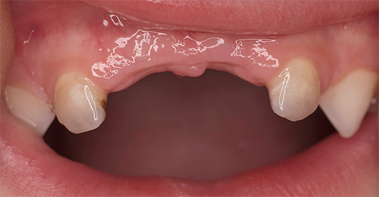 Outro problema associado a danos muito precoces e graves nos dentes de leite com cárie é a incapacidade da criança de mastigar os alimentos normalmente.