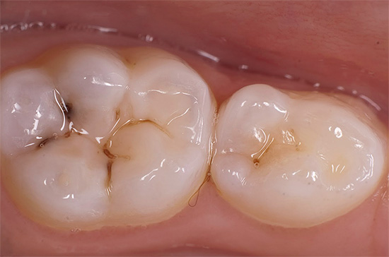 A foto mostra um exemplo de cárie de fissura em um dente de leite para mascar.