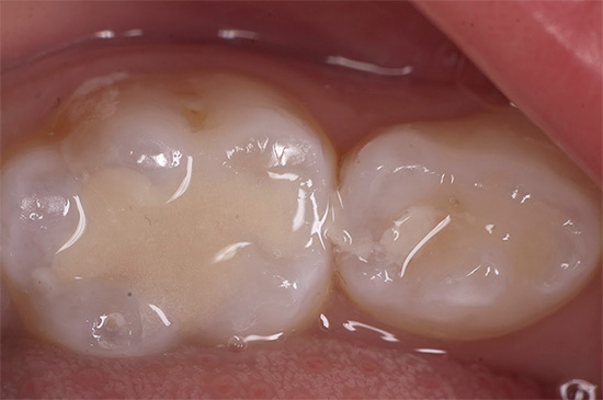 E parece um dente de leite curado com recheio