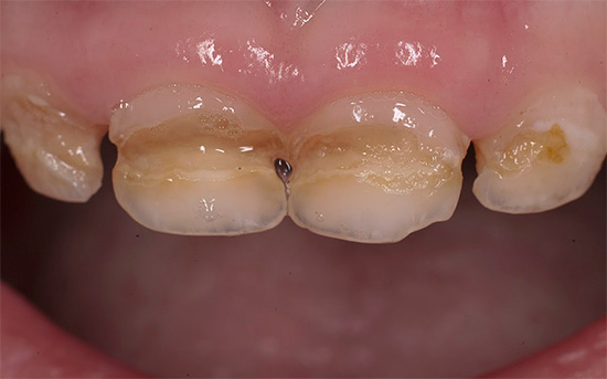Um exemplo de cárie por mamadeira: os pais precisam tentar não levar os dentes do filho a tal estado e, aos primeiros sinais de destruição, consultar um dentista.