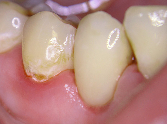 Nós nos familiarizamos com as características da cárie cervical e as principais razões para o seu aparecimento nos dentes ...