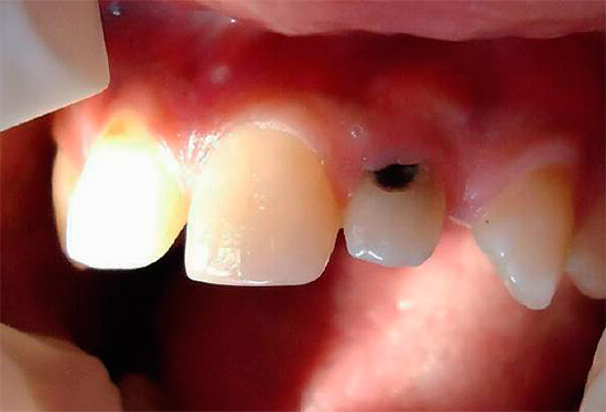 Outro exemplo de lesão profunda de cárie na região cervical do dente da frente superior.