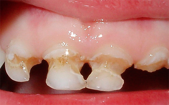 Cárie circular de dentes decíduos