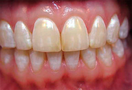Com fluorose endêmica, os dentes também podem ter manchas de várias cores, do branco ao marrom.