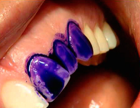 O corante especial enverniza teimosamente apenas os tecidos dos dentes afetados pela cárie, enquanto que, no caso de fluorose e hipoplasia do esmalte, eles permanecem sem pintura ao lavar a solução de coloração.