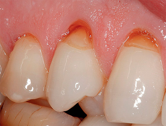 A foto mostra um exemplo de defeitos em forma de cunha nos dentes superiores.