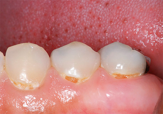 E parece cárie cervical