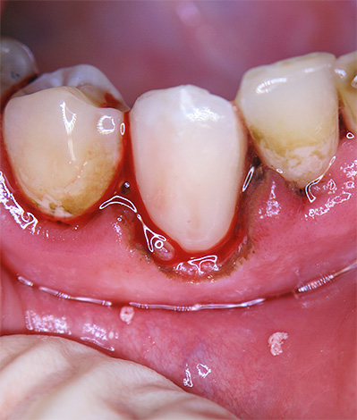 A instalação de um preenchimento na região cervical pode ser significativamente complicada ao colocar fluido gengival e sangue no campo de trabalho.