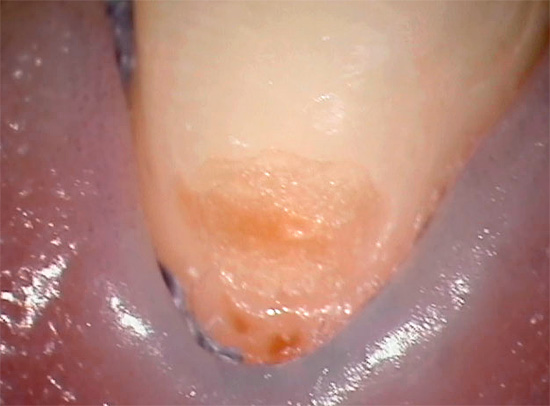 Uma lesão de dente cariado na região cervical no estágio inicial de desenvolvimento pode se parecer com isso.