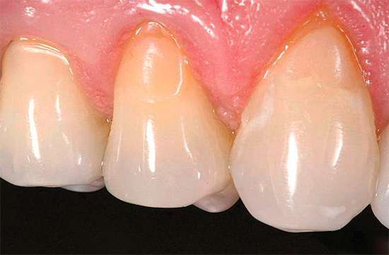 E assim os dentes cuidam do tratamento - os recheios estabelecidos na área do pescoço são perceptíveis.
