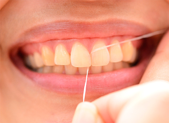 O uso do fio dental permite limpar efetivamente o espaço interdental, onde a cárie dentária geralmente pode se desenvolver secretamente.