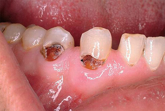 E este é um caso mais negligenciado de cárie cervical, quando a dentina sob o esmalte é afetada.