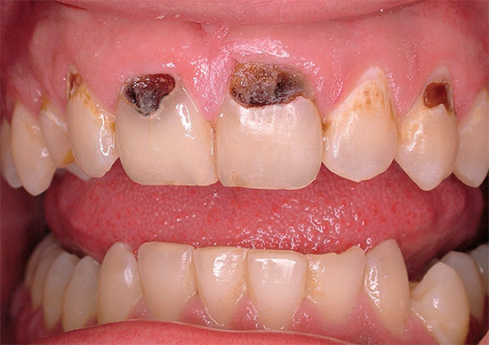 A cárie cervical nos dentes da frente pode arruinar muito o sorriso de uma pessoa.
