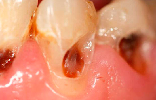 A foto mostra um exemplo de cárie cervical profunda.