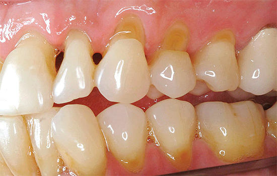 Devido ao afinamento do esmalte na região cervical, o dente se torna muito sensível a vários tipos de irritantes, incluindo o ar frio.