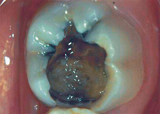 La foto mostra un esempio di una profonda cavità cariata su un dente da masticare.