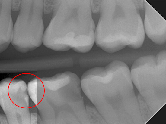 Questa radiografia mostra chiaramente una carie per carie profonde, che sarebbe invisibile con un semplice esame visivo.