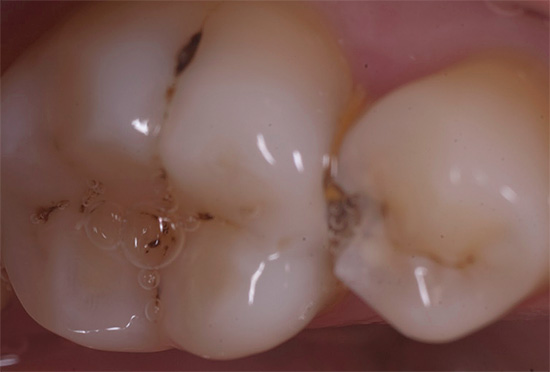 Carie profonde sulle superfici di contatto dei denti