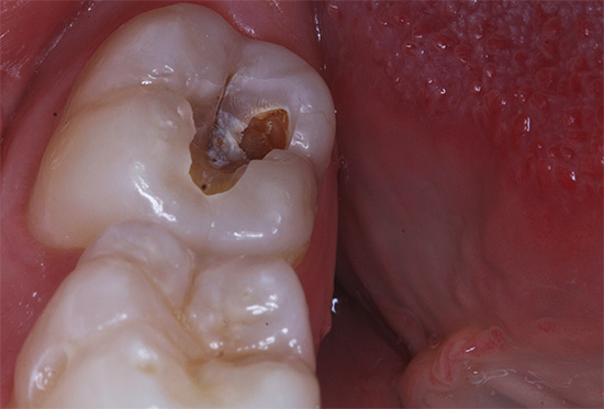 Con una cavità così profonda, la probabilità di danni alla camera pulpare del dente è molto alta.