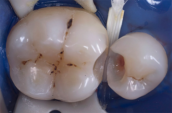 E così gli stessi denti sembrano con una cavità già formata sotto il sigillo.