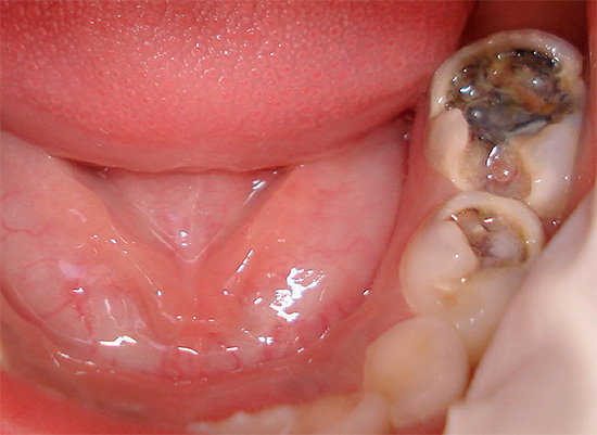 Carie profonde sui denti da latte da masticare del bambino