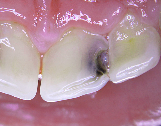 La foto mostra una profonda carie sui denti anteriori