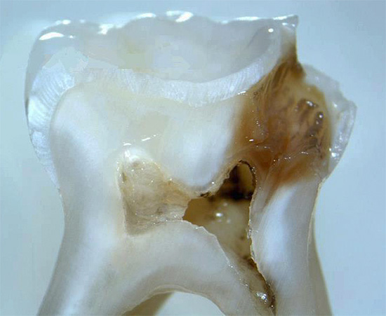 Una fetta di un dente reale con una profonda cavità cariata, che raggiunge quasi la camera della polpa.