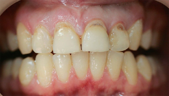 Quando compaiono i primi segni di carie cervicale, è necessario contattare immediatamente il dentista, senza aspettare che la situazione peggiori.