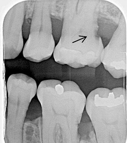 L'esame radiografico aiuta a rilevare la carie di cemento nei casi in cui il rilevamento visivo è difficile.