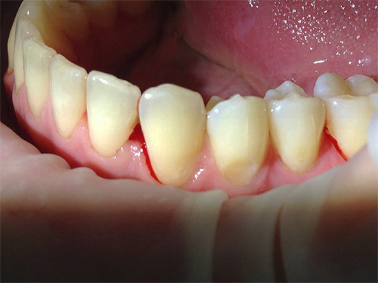 La foto mostra un dente con un difetto gengivale prima del trattamento