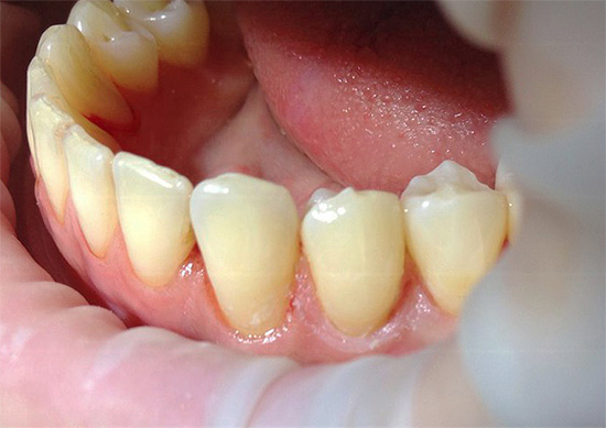E sembra lo stesso dente con una guarnizione già installata - è praticamente invisibile.