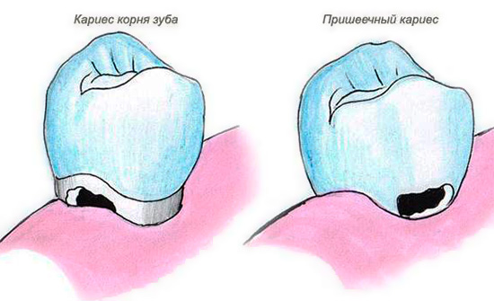 L'immagine mostra la differenza tra la carie cervicale e la cariata distruzione della radice del dente.