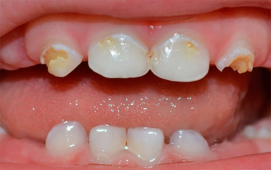 I denti da latte dei bambini piccoli sono particolarmente vulnerabili alla carie, pertanto è importante che ogni genitore abbia una chiara idea di come proteggere il bambino da tali problemi.