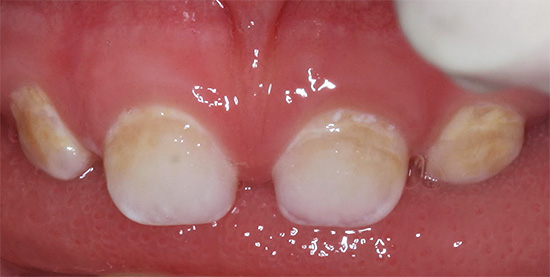 E così la carie dei denti decidui guarda allo stadio iniziale dello sviluppo - non ci sono ancora cavità cariate profonde, ma lo smalto è già molto demineralizzato.