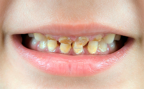 Di norma, in assenza di un'igiene orale adeguata, la carie colpisce immediatamente molti dei denti da latte del bambino.