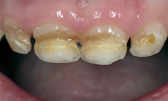 Decadimento circolare dei denti decidui