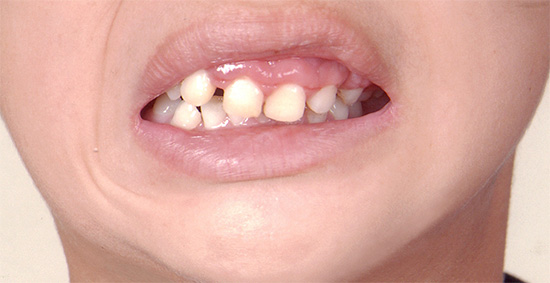 La perdita prematura dei denti primari spesso comporta malocclusione e persino un cambiamento nella forma del viso.