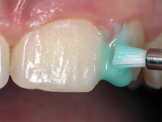 Oggi, la cosiddetta tecnologia ICON, che non richiede la preparazione di un dente con un trapano, è ampiamente utilizzata per trattare la carie nella fase spot.