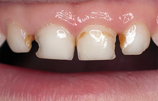 Carie sui denti anteriori del bambino