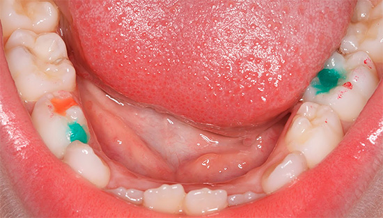 L'uso di otturazioni colorate nei denti da latte consente al bambino di essere interessato e motivato per il trattamento.