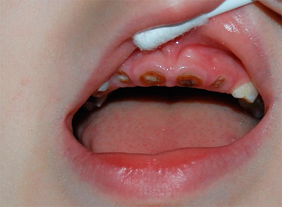 Senza un'adeguata cura, i denti da latte del bambino in tenera età possono semplicemente marcire sotto la radice.