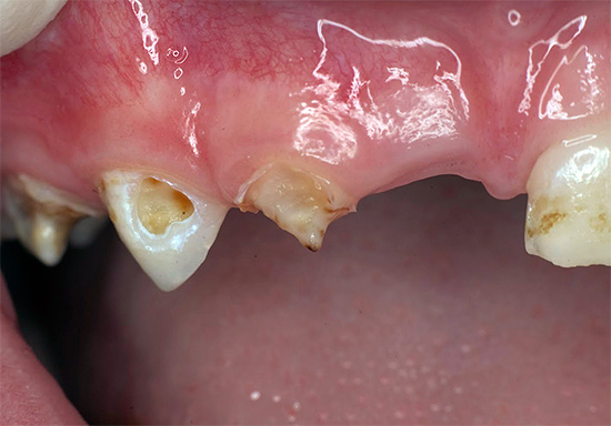 La foto mostra un esempio di decadimento avanzato dei denti decidui