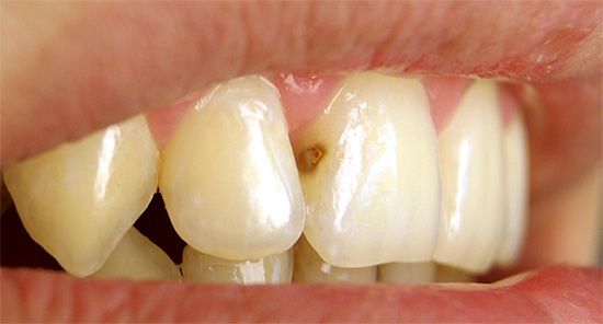 Como regra, as pessoas prestam atenção especial às cáries nos dentes da frente, pois isso afeta diretamente a aparência da pessoa e a impressão geral dela.