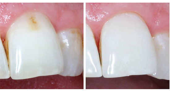 É assim que o dente da frente fica antes e depois do tratamento usando a tecnologia Aycon
