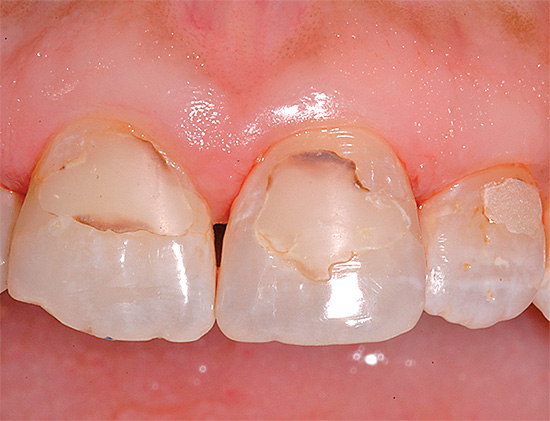 A foto mostra um exemplo de cárie secundária nos dentes da frente, sob recheios.