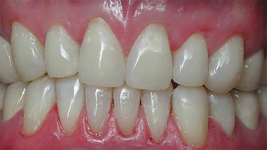 Os dentes da frente devem ser o mais naturais possível após a restauração.