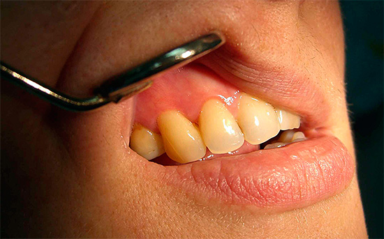 Na maioria dos casos, o custo do tratamento de cárie nos dentes da frente é aumentado.